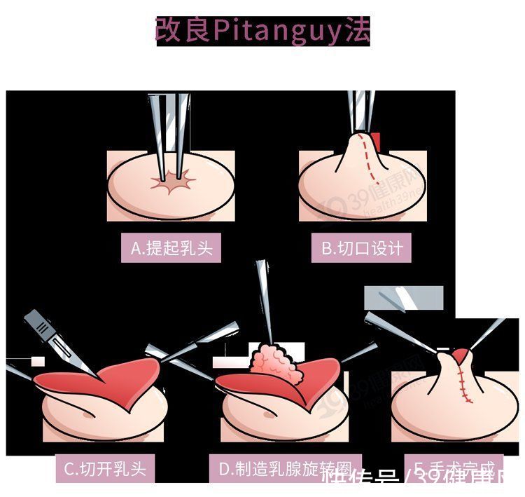 乳房|什么是“乳头内陷”？要怎么治疗？2个原因，可能让它暂时消失