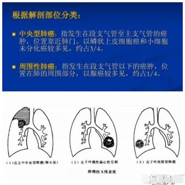  中晚期|为什么肺癌病人早期一般没有症状表现，一旦出现症状，均为中晚期