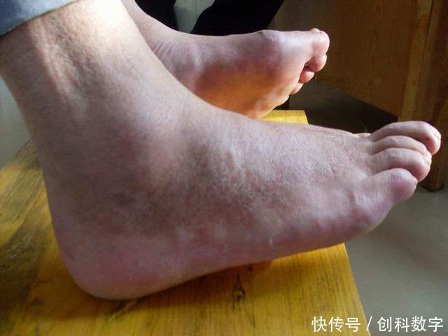 痛风|降尿酸“高手”藏在厨房,平时这样吃,尿酸降下来,痛风不见了