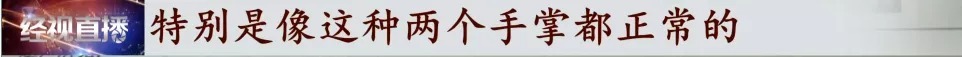 胎儿|宝宝出生缺失四根手指,家长质疑孕检误诊,涉事医院回复:不存在