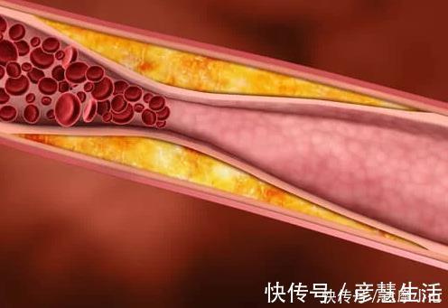1物|胆固醇高?血管油腻腻,常吃1物,打扫血管,降低胆固醇