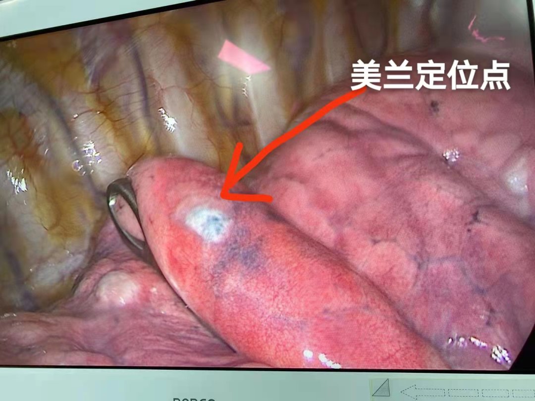 胸腔镜|【技术服务】术前CT引导下美兰定位，汶医成功开展精准肺结节切除术