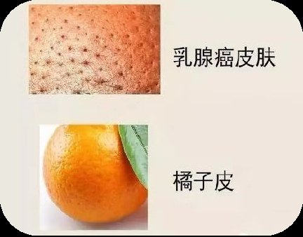 自检|乳房自检,你学会了吗?