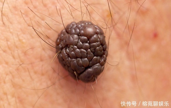 癌症来降临前,多伴有4种信号,教你3招,提前预防癌症,望周知