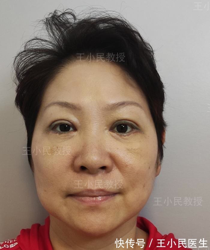 面部 王小民教授:面部线条不流畅,松弛下垂的“赘肉”才是罪魁祸首!