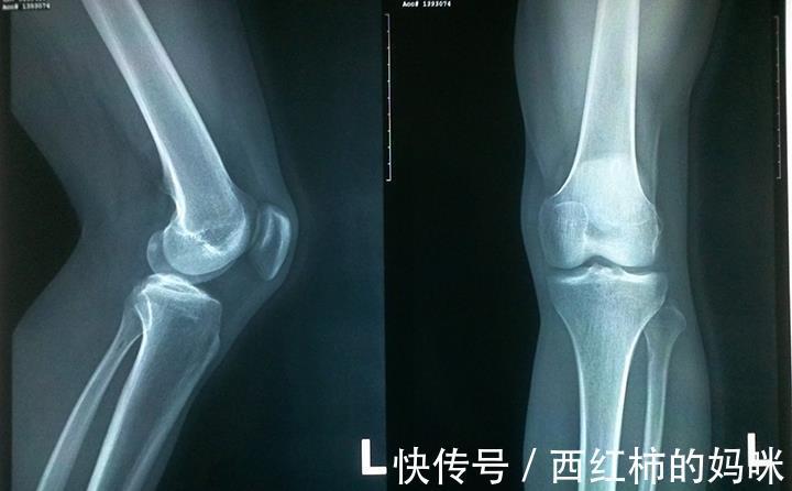 同龄人|9岁孩子全班最矮,身高比同龄人差一大截,只因睡前有这一坏习惯