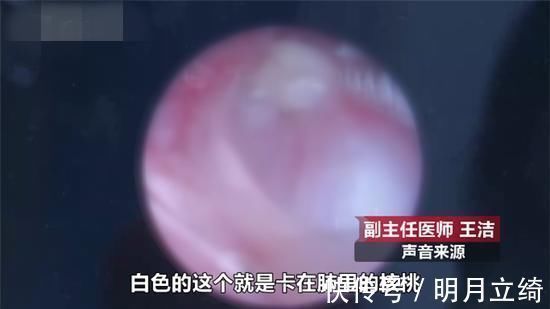 感冒|2岁男孩咳嗽不止,妈妈以为是感冒,医院拍片一看妈妈汗毛直立