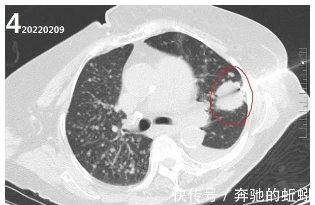 ct|如果不治疗的话,肺癌的发展速度到底有多快?