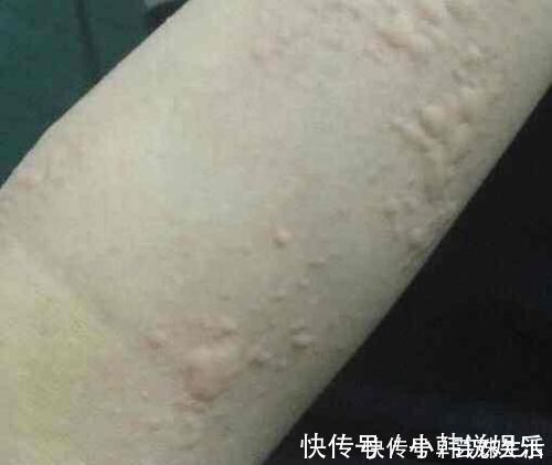 反复得荨麻疹,是由什么原因造成的?这5个