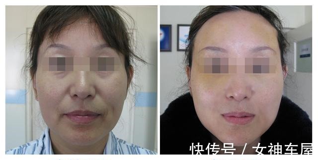 拉皮 46岁做拉皮手术是种什么体验,分享一下我的真实经历!