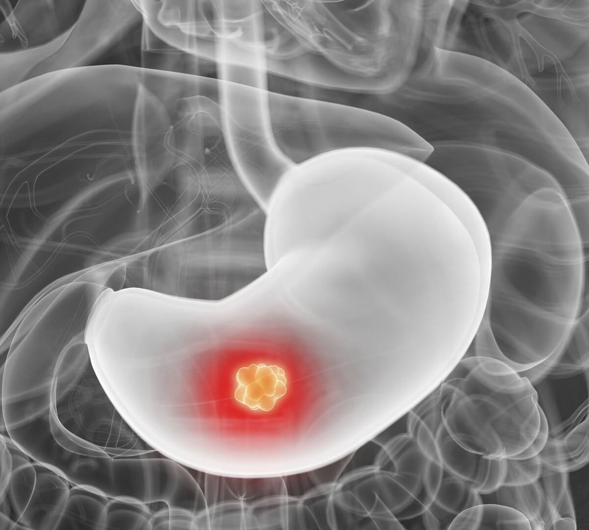 恶性|得了癌症一般多久后就会慢慢瘦医生这些是影响因素