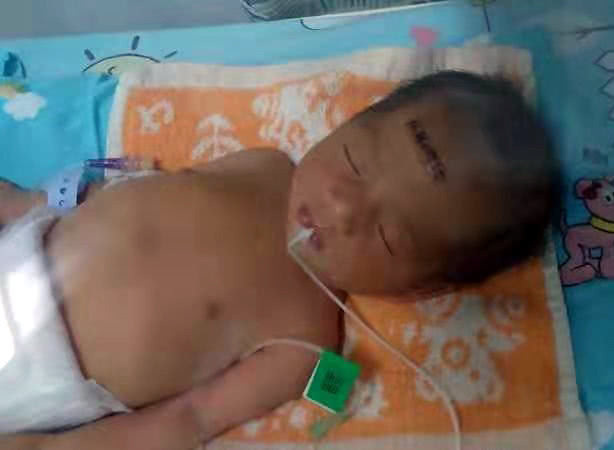 姚甜甜|早产双胞胎姐妹遭遇罕见病,出生时不足两斤,腿还没爸爸手指粗