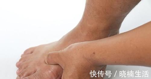 痛风|厨房这3种调味料,是尿酸加速器,吃多一点痛风发作更痛一分