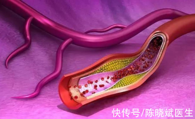 视力|3个信号发出预警,血脂已超过“警戒线”!做好4事,血脂稳稳的