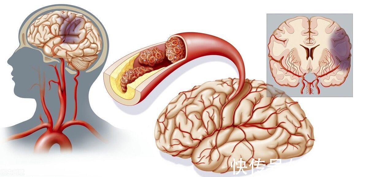 脑出血|近10年追踪研究，调查超50万中国人：原来他汀类药物可预防脑梗