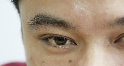 肝脏|肝硬化先上脸?脸部有什么异常,可能是肝硬化找上门了?别忽视