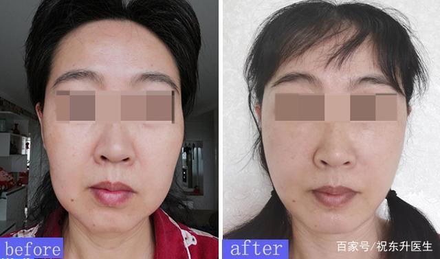 缝线 求美者说52岁,做完拉皮手术后的90天