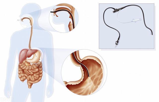 消化|女儿胃镜查出胃癌，消化科医生忠告饭后出现2种不适，千万小心