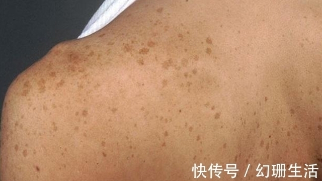 粉刺|肝脏也要“洗洗澡”,别让肝毒招来肝硬化,威胁我们身体