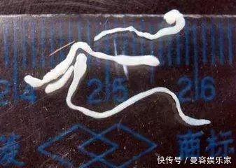 小男孩|7岁小男孩,脑中发现8厘米长虫,医生孩子妈太无知,害了孩子
