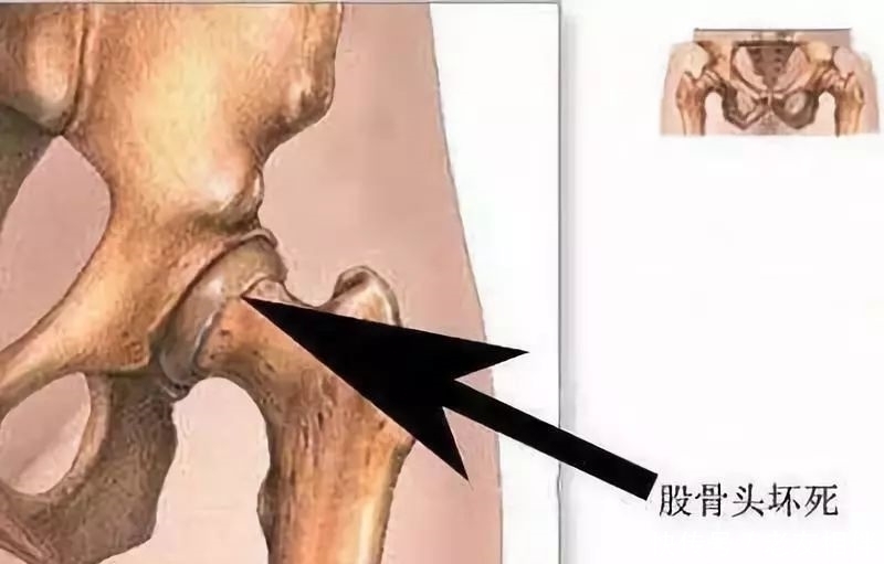 要命|髋关节疼起来真要命，到底为什么这么痛？要怎么治疗？