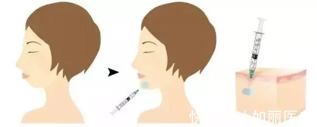 手术 玻尿酸隆鼻可以维持多久?1年?术前准备+术后护理要知道的事!