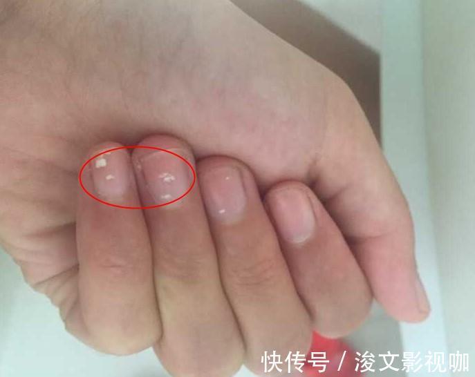 竖棱|肾不好的人, 手上3个表现“出卖你”, 很容易看出来