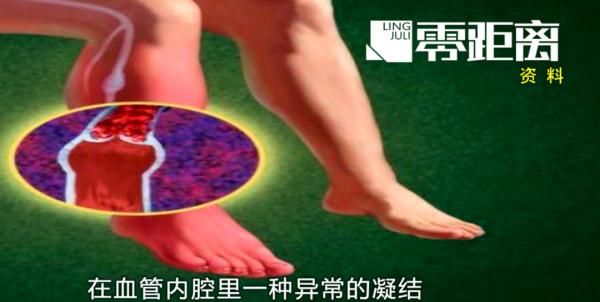 血管内皮|15岁男孩突发“血栓”！医生：宅家久坐，还不爱喝水……