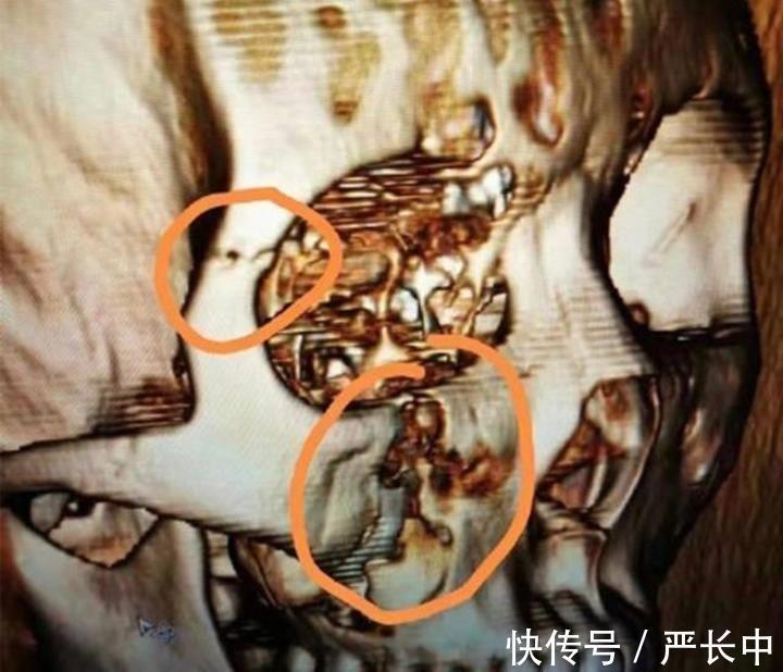 暴力犯规|CBA上演暴力犯规,廖三宁2根骨头被当众打断,114号裁判却无视!