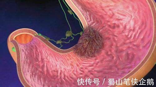 幽门螺杆菌|胃溃疡是幽门螺杆菌？胃病是不是都要“杀菌”？也许你一直没明白