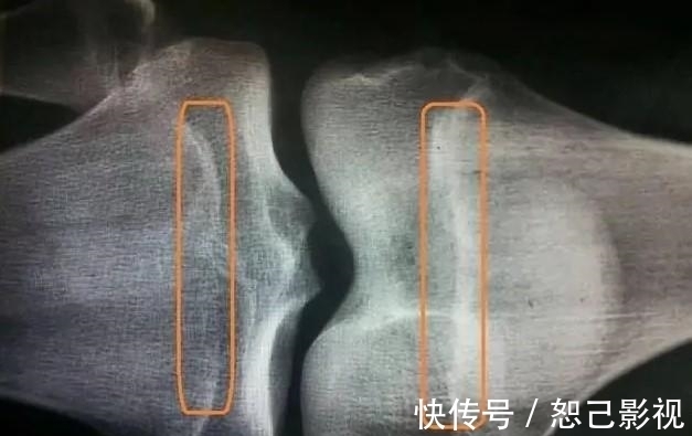 身高|12岁女孩身高145cm,医生:孩子若有两个特征,预示骨垢线要闭合