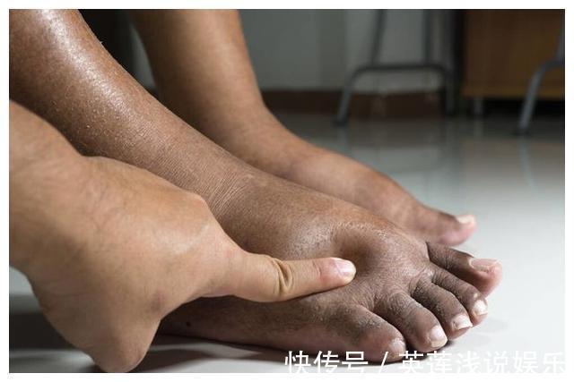 慢性肝炎|体内有“癌”,手脚先知!医生提醒:手脚出现这4种变化,不要拖