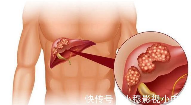 喝酒|40岁女子从来不喝酒, 发现肝癌4个月后离世, 医生说2件事害了她!