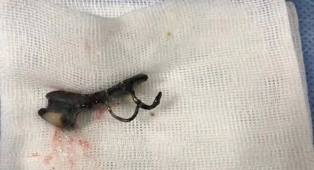 支气管|消失的假牙钩在气管上,杭州大伯“心肺都要咳出来”!这些动作不要再做了!