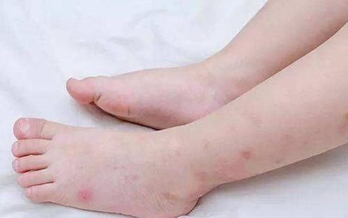 止痒|儿科医生忠告:宝宝被蚊虫叮咬后,家长不要再这样做了