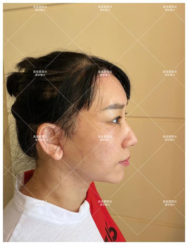 面部 51岁小拉皮术后1个月,我想跟大家说点真心话