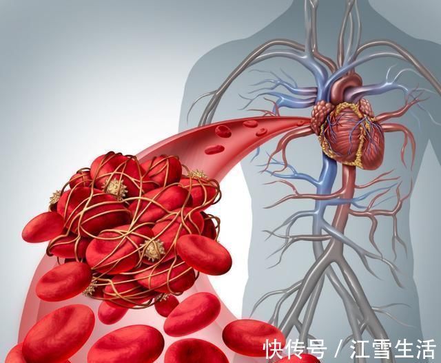 通血管|吃木耳能通血管北大教授大错特错,真正能通血管的是这1件事