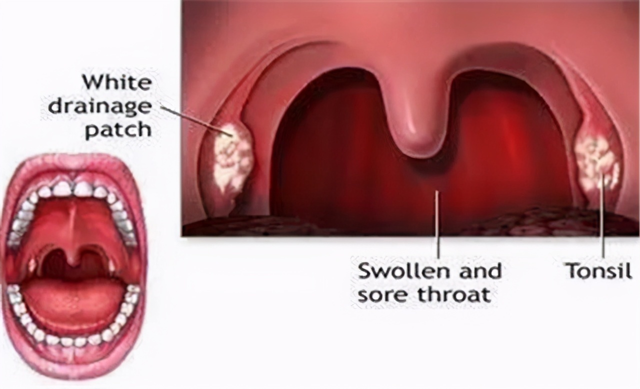 慢性咽喉炎|慢性咽炎就诊，却查出了食管癌，二者该如何分辨医生告诉你