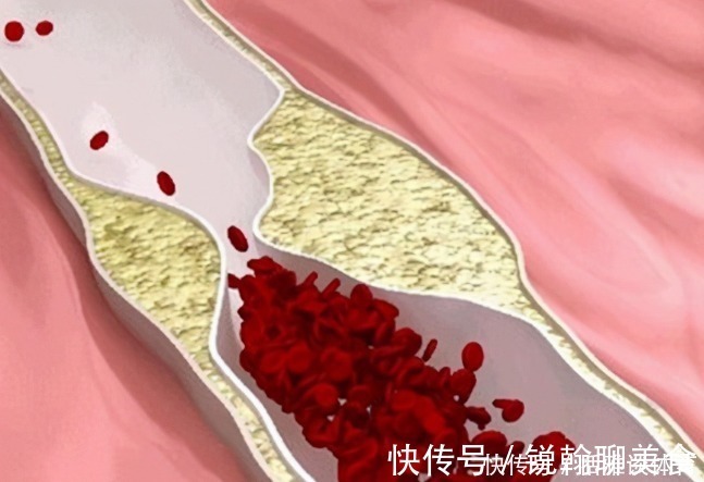 组织细胞|怎么知道“血管堵没堵”？教您几个方法，轻松解决，很实用