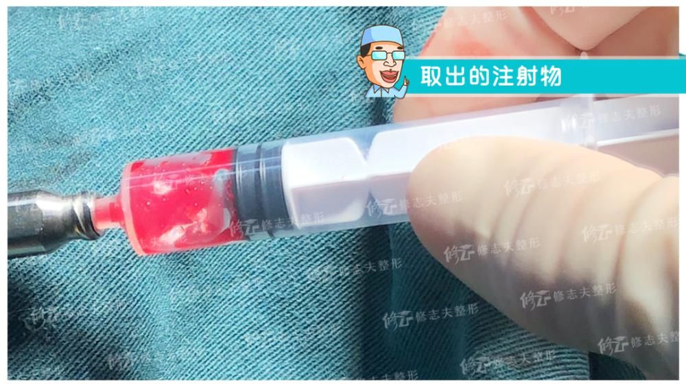  鼻尖|鼻修复时取出的东西都有啥？感受一下！