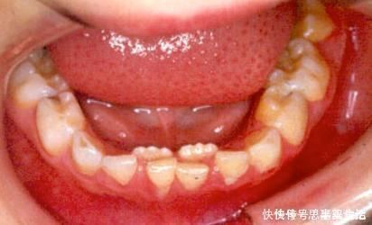 孩子|送给孩子正在换牙的父母们,你们一直都做错了什么?