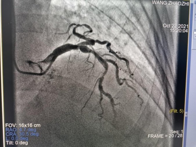 我为群众办实事：DSA正式投入使用，绩溪县人民医院迎来“介入时代”