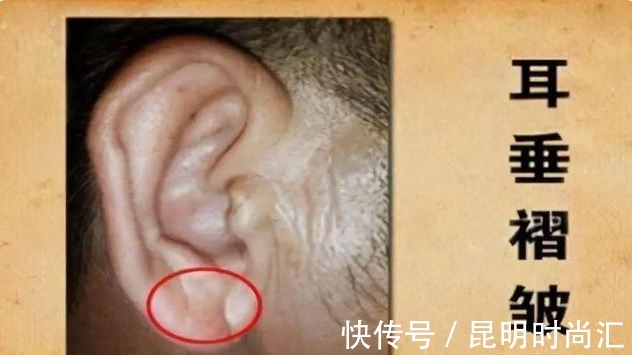 堵塞|血管堵塞的人,脸上会出现5种表现,若没有,恭喜你体内没有血栓