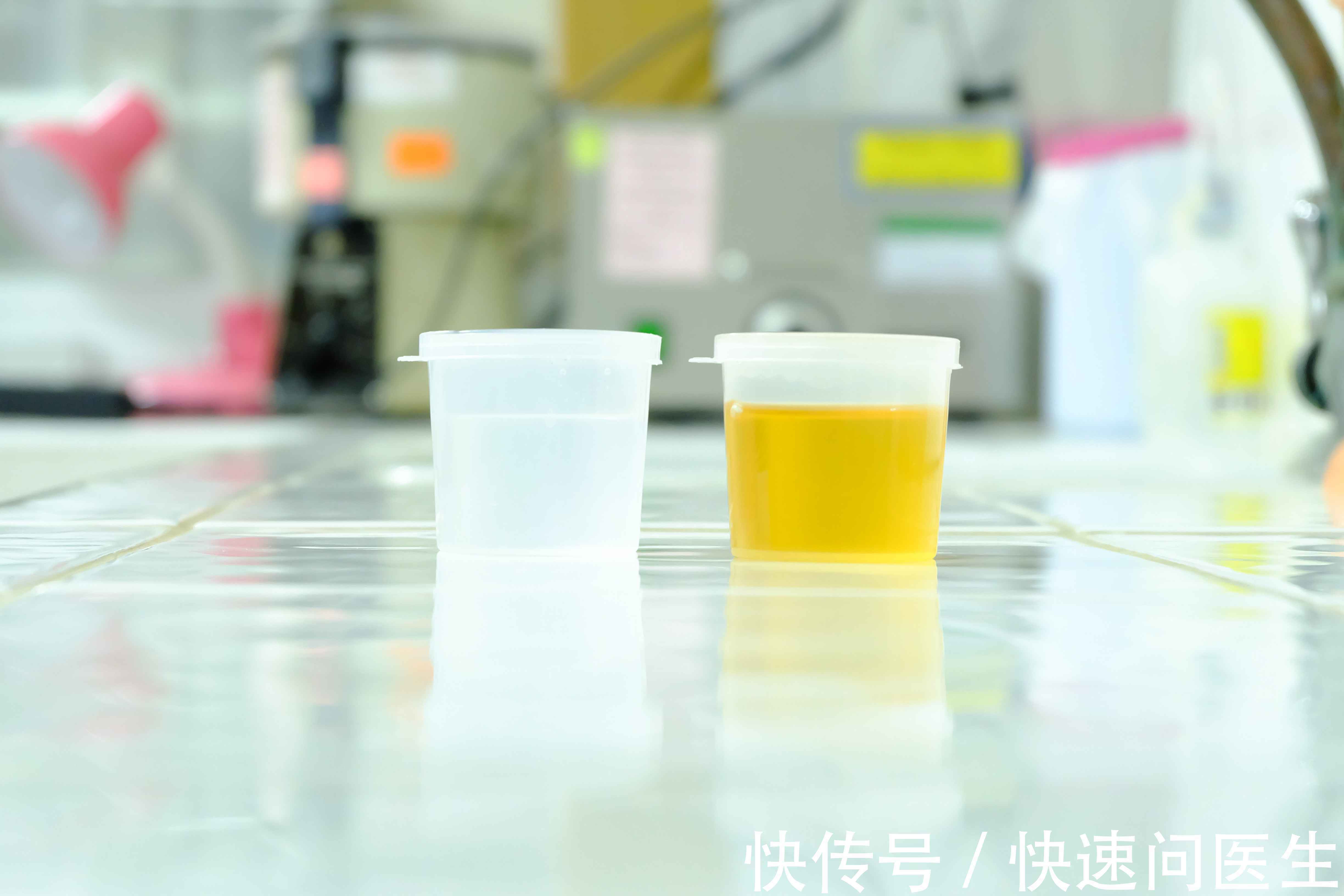 小便|糖尿病只是夜尿增多而已?糖尿病不用治疗?一文解析