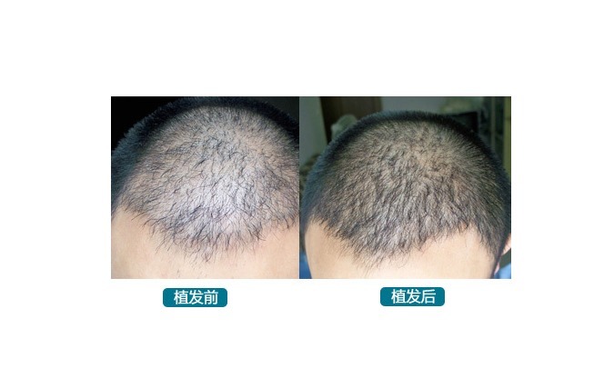 效果好 黑米3D纹发:关于植发的一些事实《9-11》