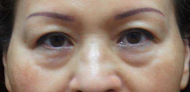 干姜|“眼袋”威胁颜值的最大杀手,老中医用一味药搞定,送给天下女人