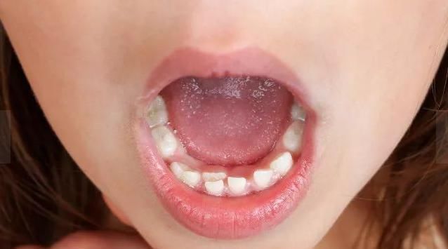 不良习惯|吃的太“好”了医院每天接诊20多个双排牙孩子,家长别再这样喂了