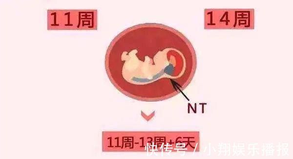 b超|孕妈必知的NT检查, 一篇文章给你讲透咯