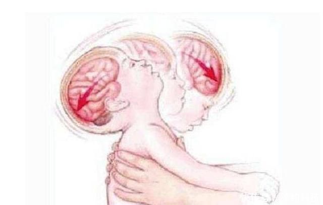 婴儿|婴儿突发脑出血,医生揭露了罪魁祸首,很多父母都在犯!