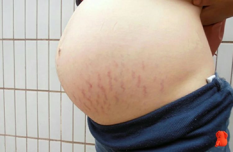 准妈妈|“孕期妊娠纹”都会挑什么人生长？这四类准妈妈易中招，有你吗？